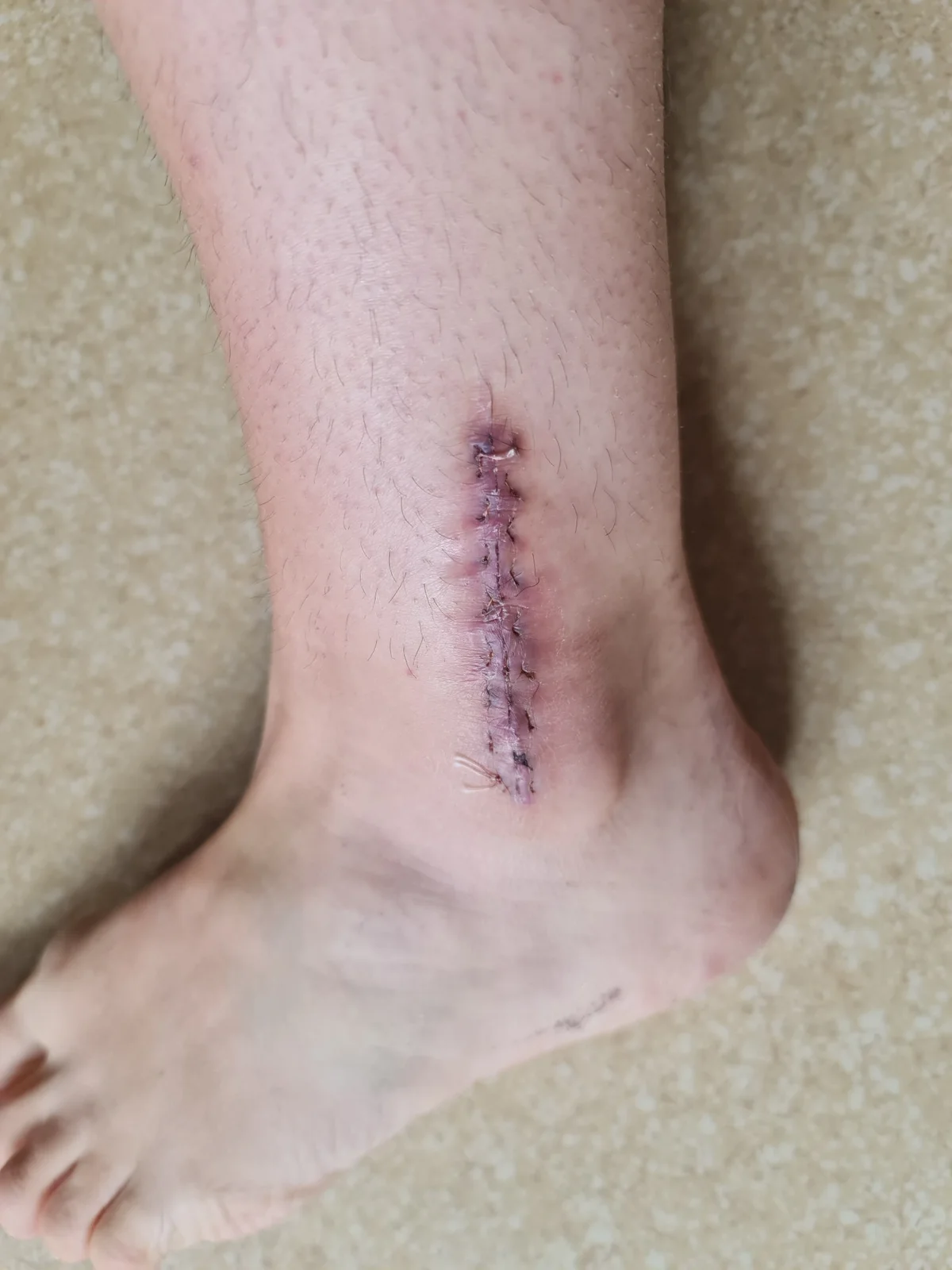 État de la cheville après une fracture survenue en compétition — photo 1