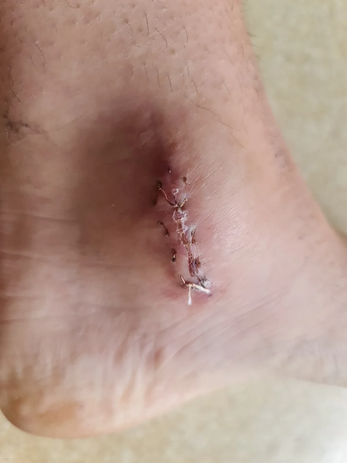 État de la cheville après une fracture survenue en compétition — photo 2