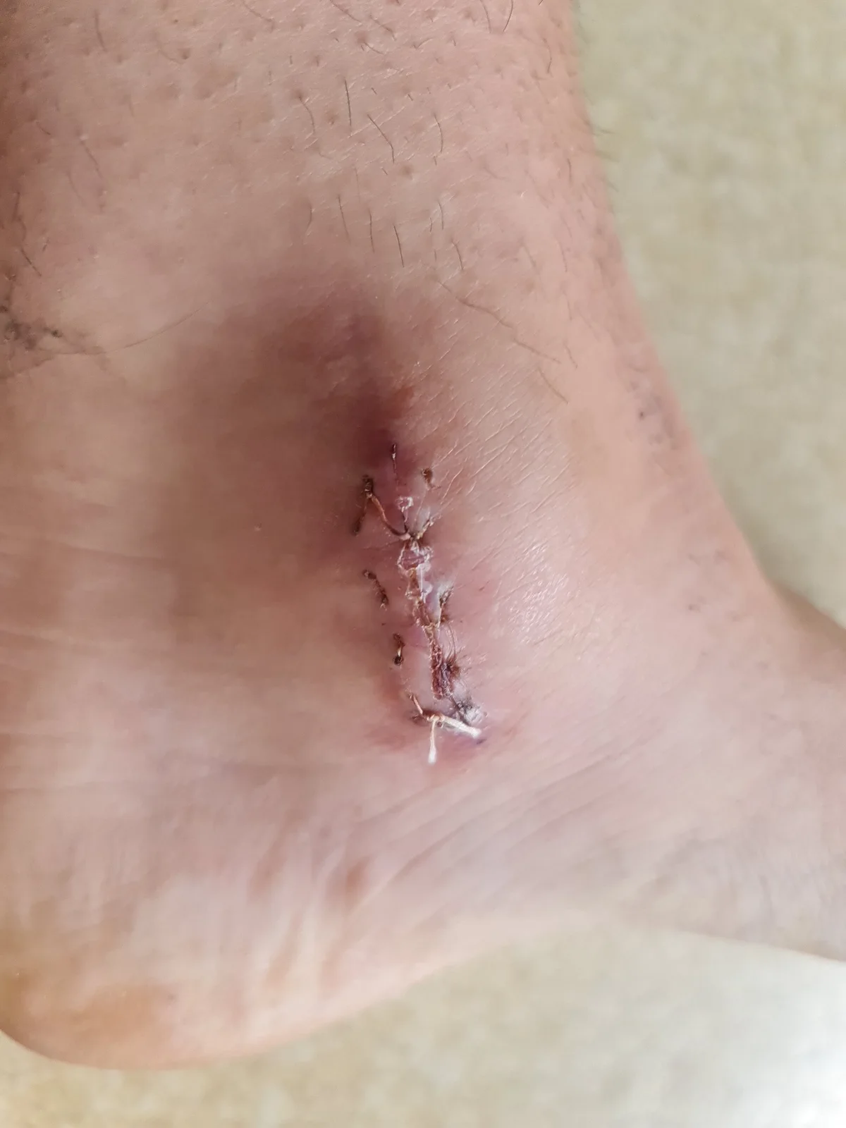 État de la cheville après une fracture survenue en compétition — photo 3
