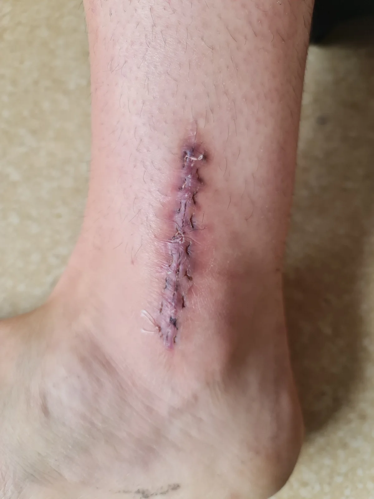 État de la cheville après une fracture survenue en compétition — photo 4