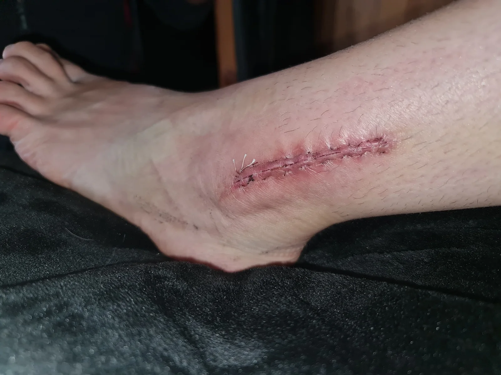 État de la cheville après une fracture survenue en compétition — photo 5