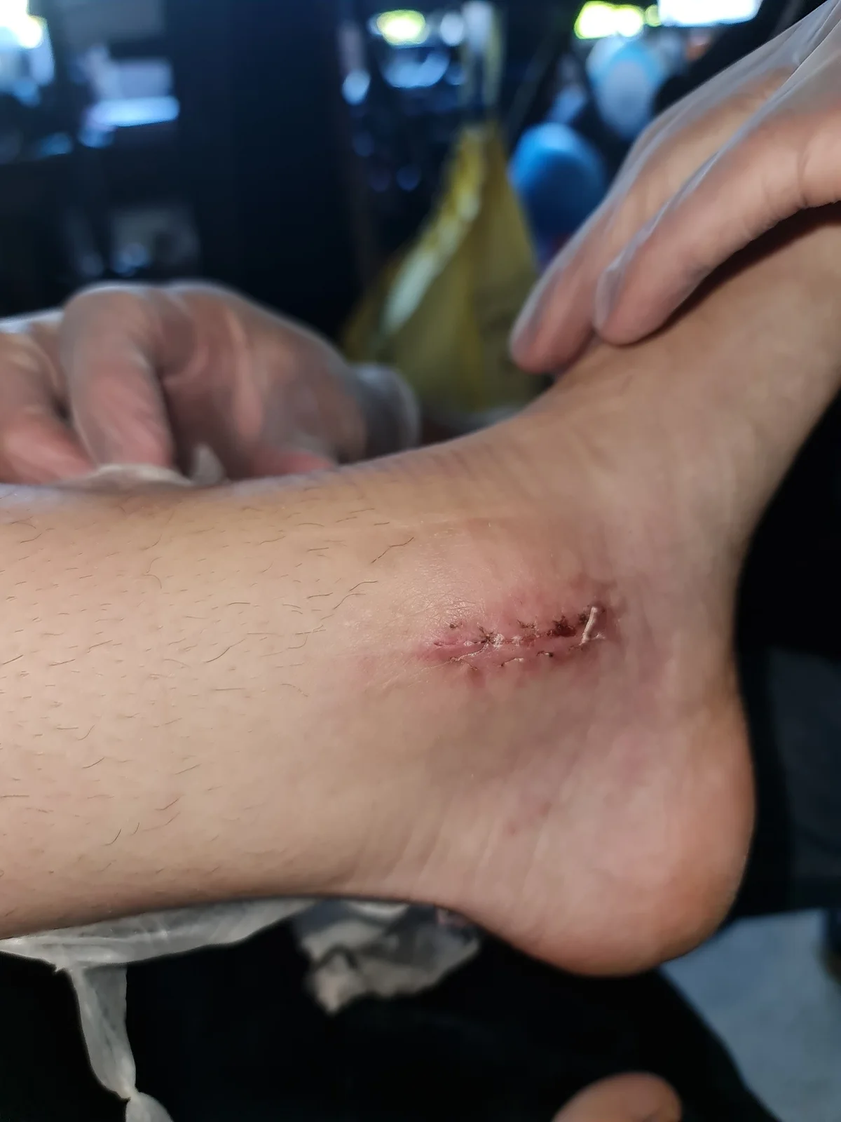 État de la cheville après une fracture survenue en compétition — photo 7