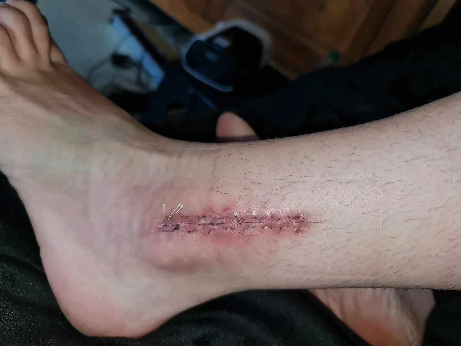 État de la cheville après une fracture survenue en compétition — photo 9