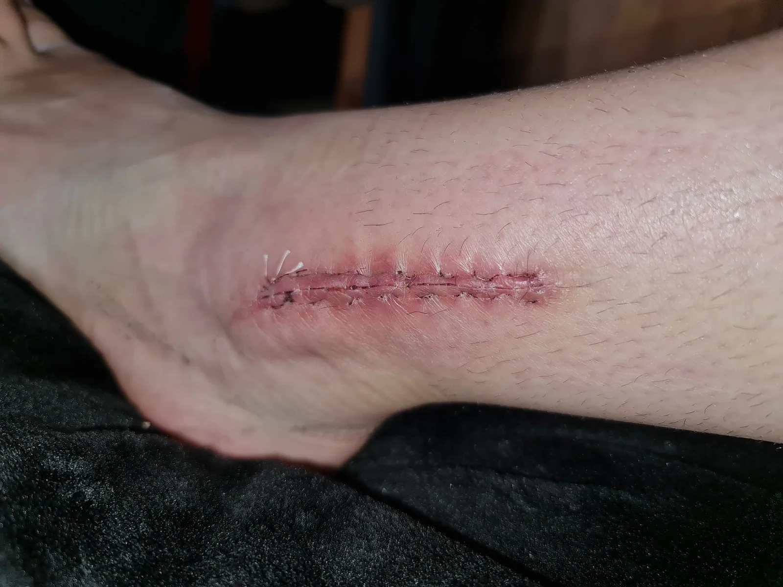 État de la cheville après une fracture survenue en compétition — photo 10