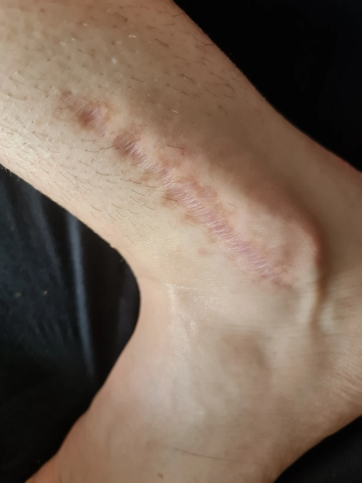 État de la cheville après une fracture survenue en compétition — photo 11